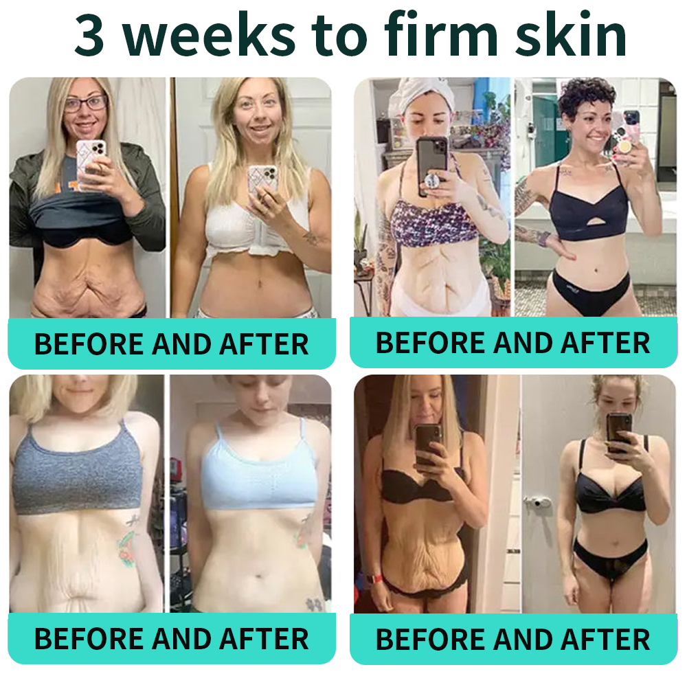 Vitalisys® PDRN Complex Peptide Capsule Cream|Anti aging, firming and lifting muscles Skin care, removal of stretch marks, breast enhancement, removal of chest lines, and skin repair.